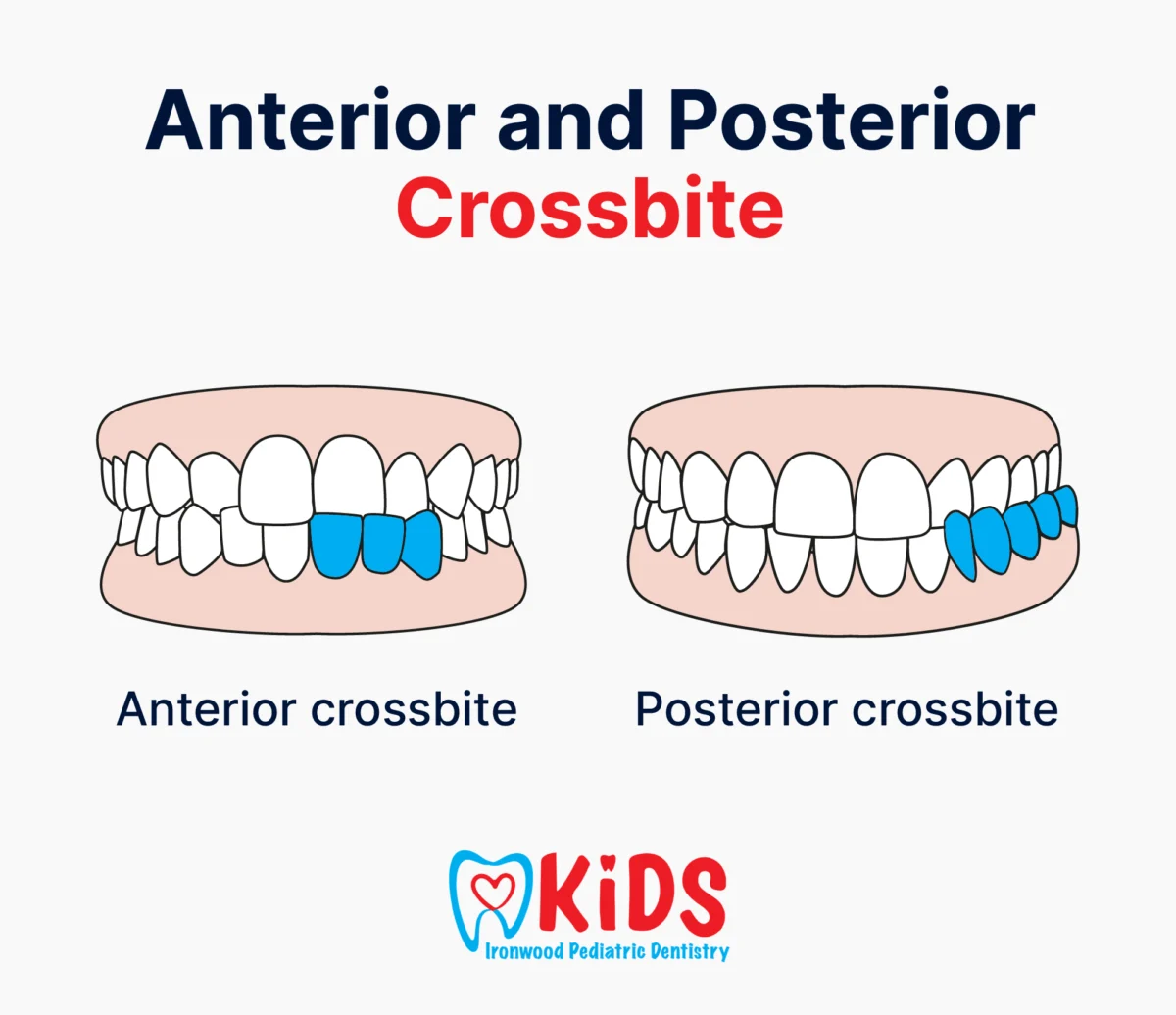 A diagram showing an anterior and a posterior crossbites.