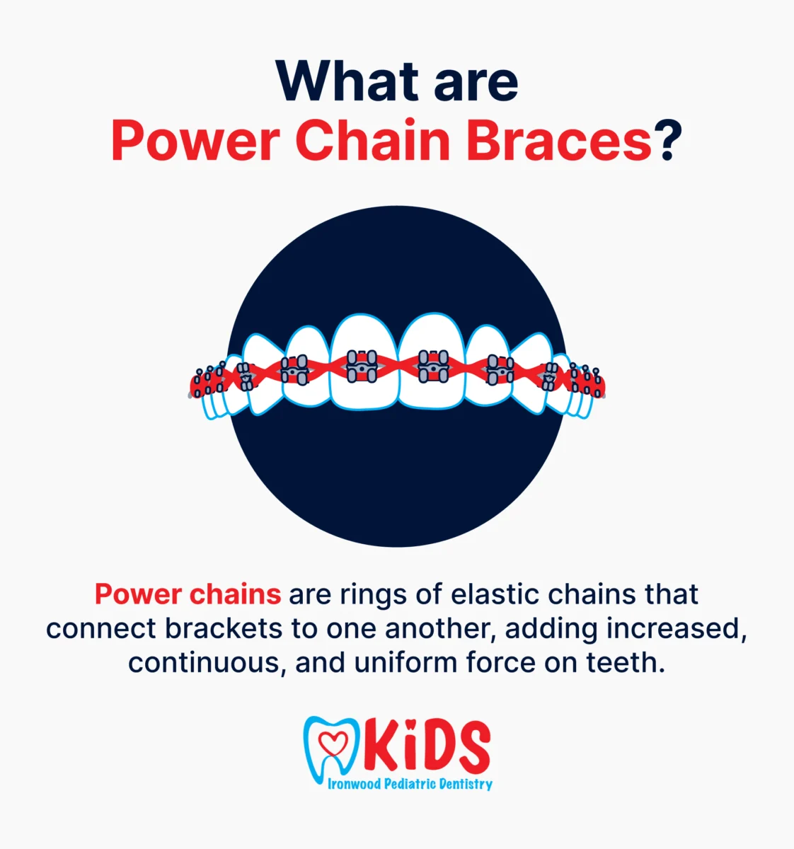 A graphic defining what power chain braces are.