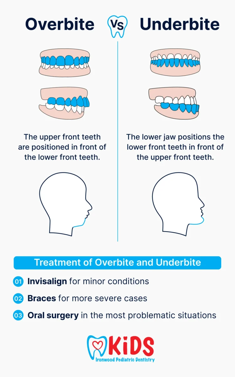 A custom graphic listing the differences between overbites and underbites.