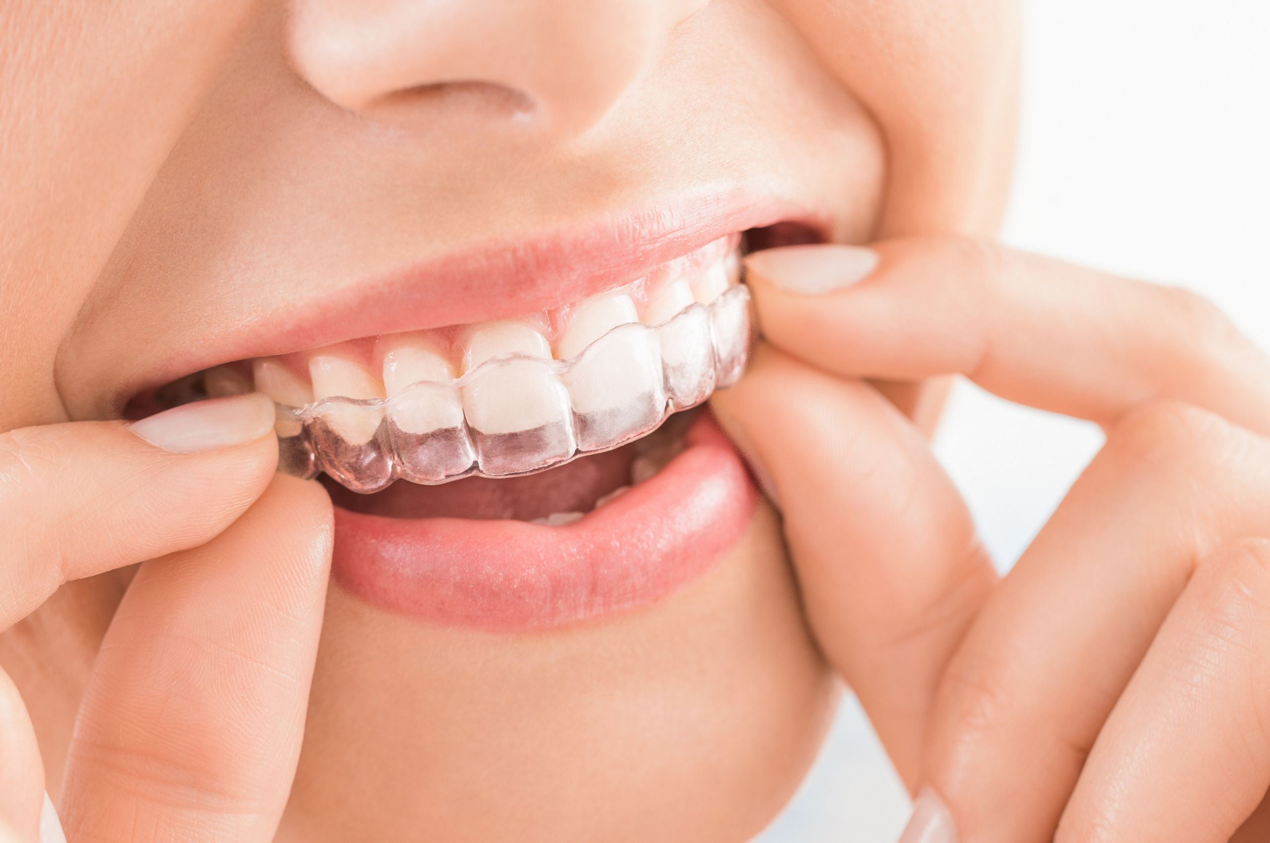 Pros and Cons of Invisalign for Kids