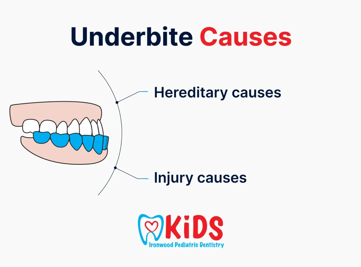 A graphic listing the types of underbite causes.