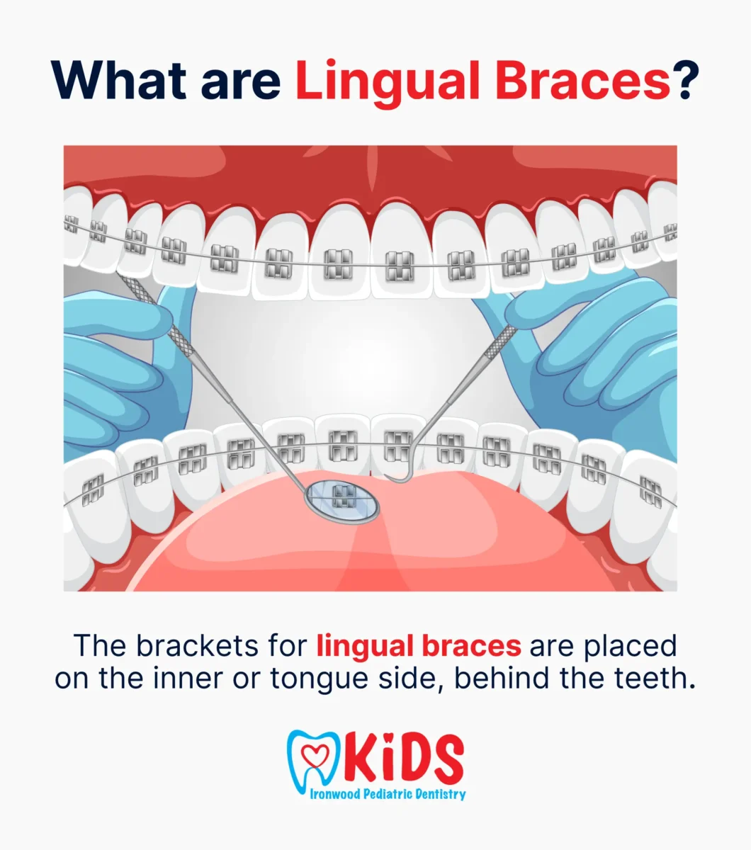 A custom graphic describing what lingual braces are.