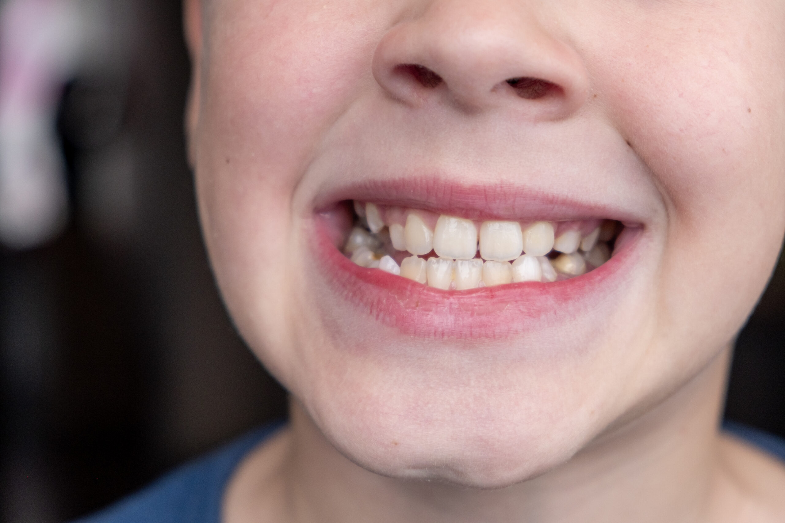 Child with brooked, crossbite teeth.