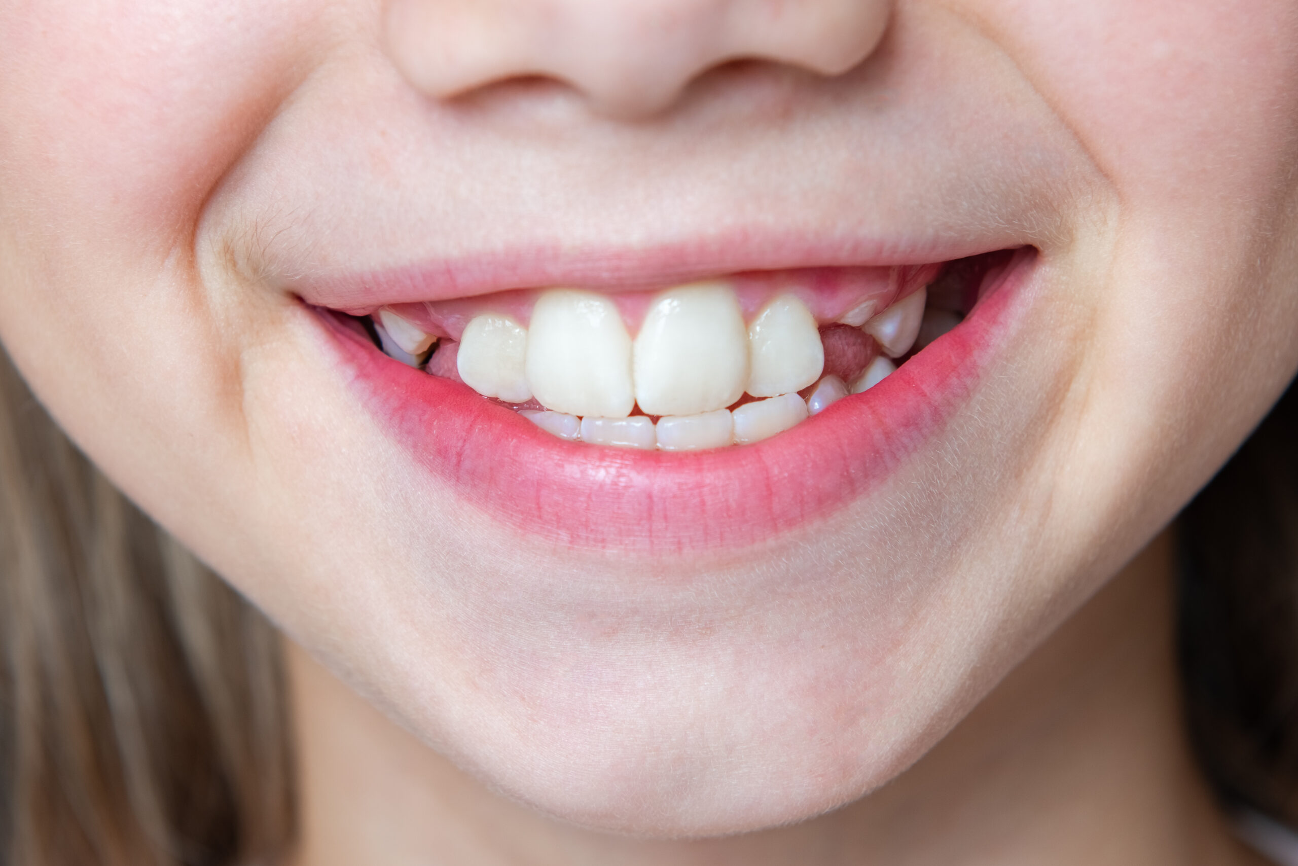 A smiling child with slightly crooked teeth.