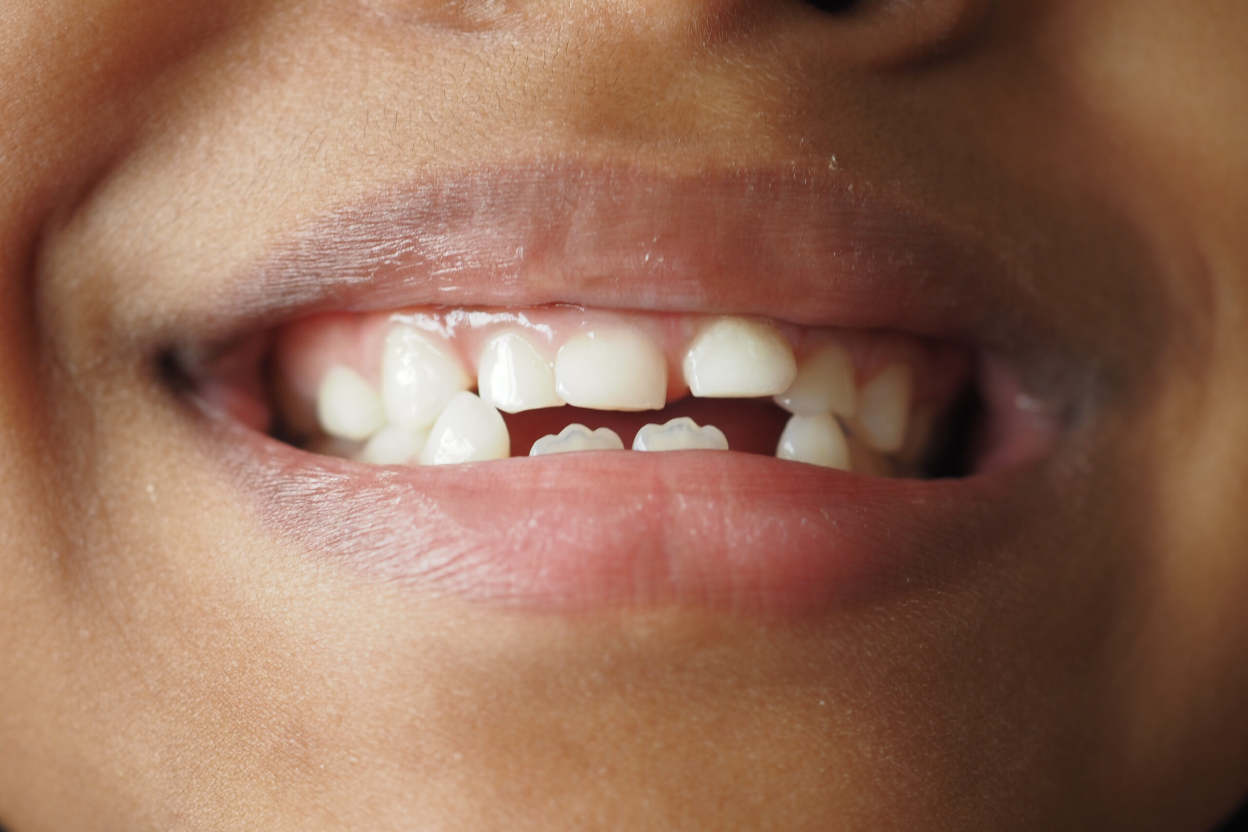 An image of a child with an open bite.