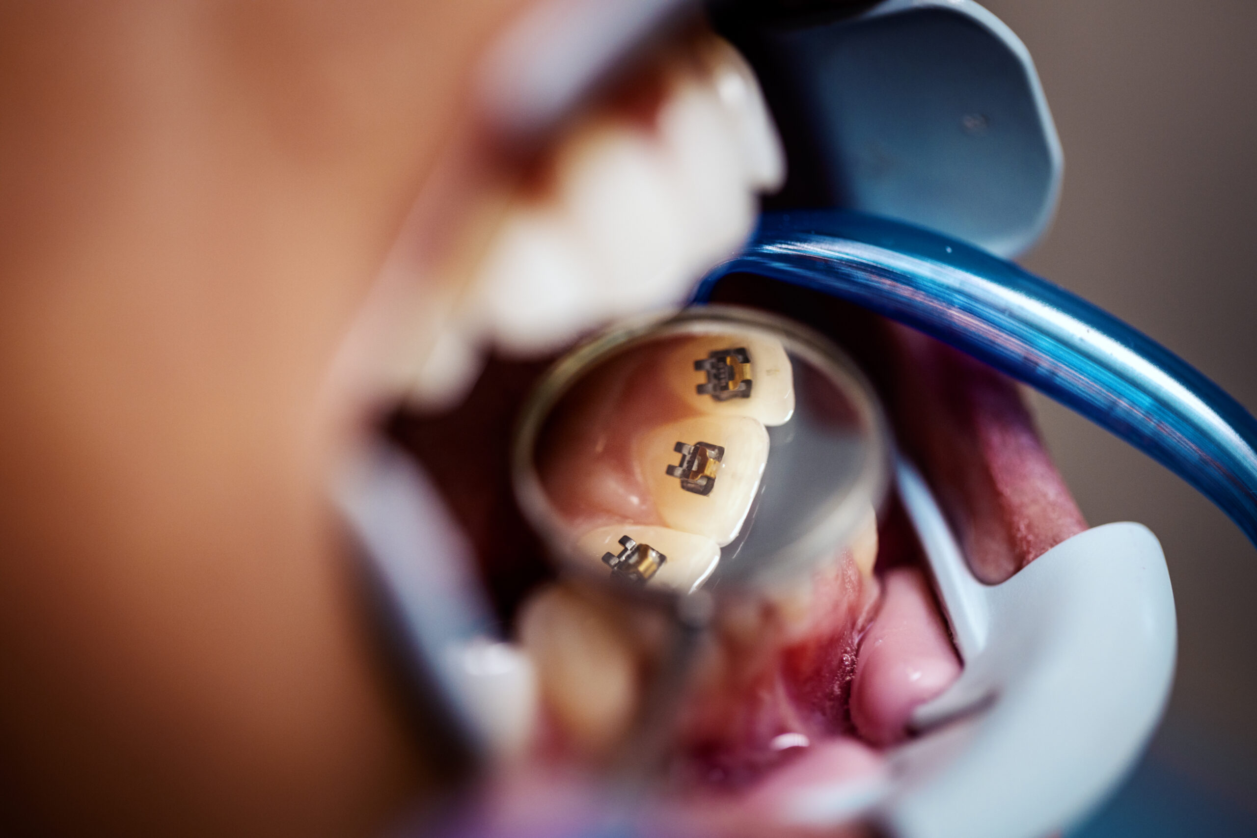 A patient wearing lingual braces.