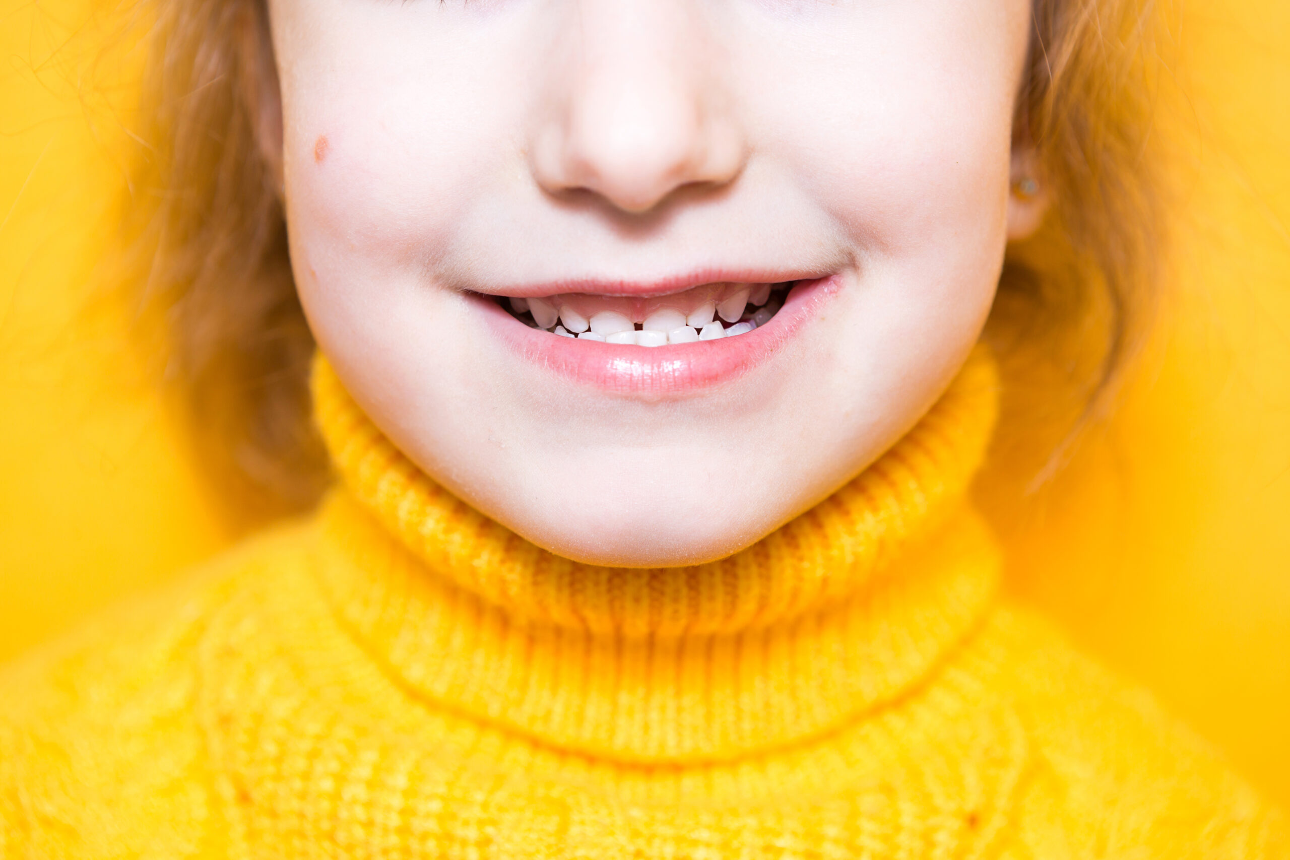 A child with an underbite.