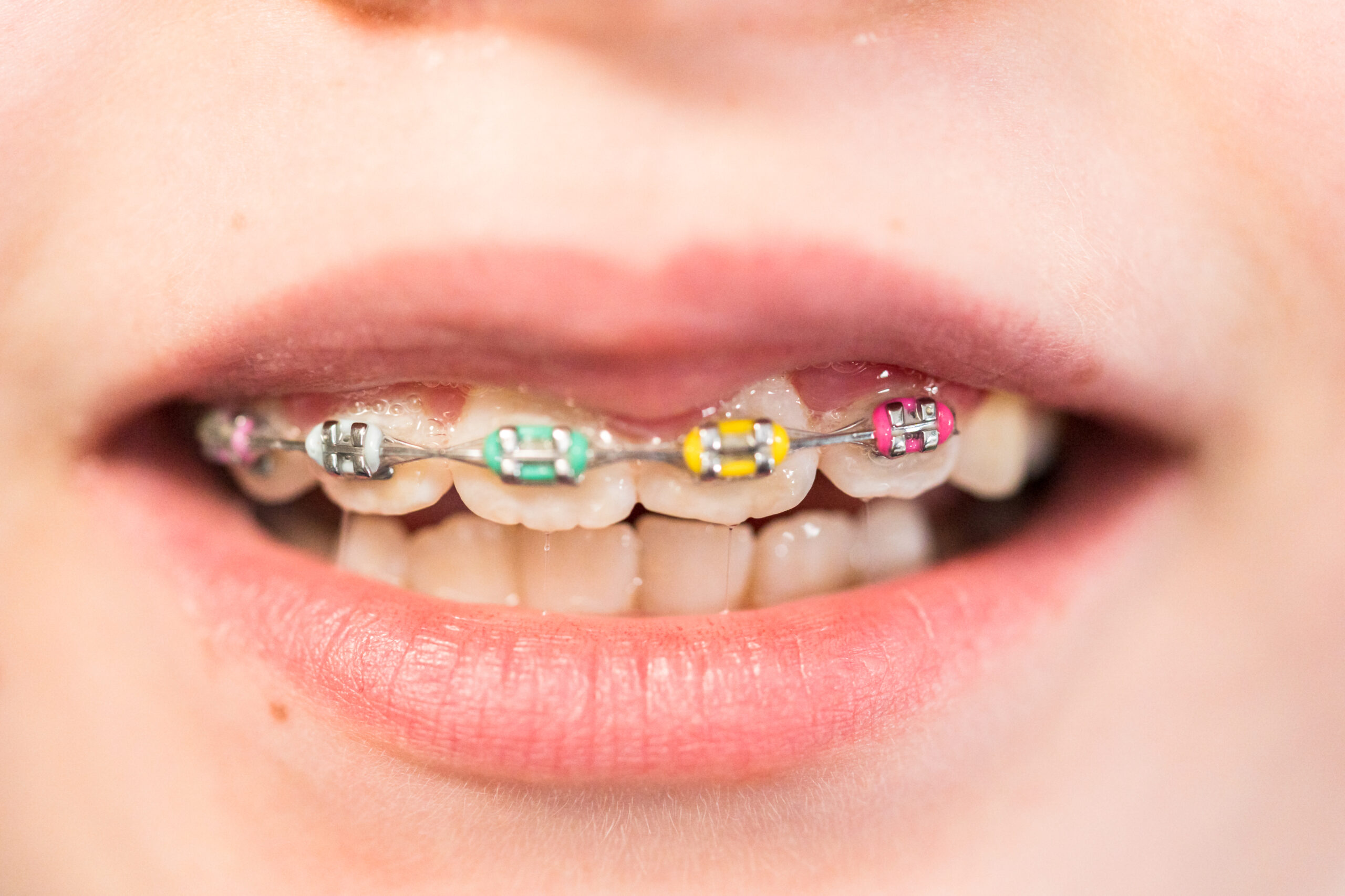 Child with braces.