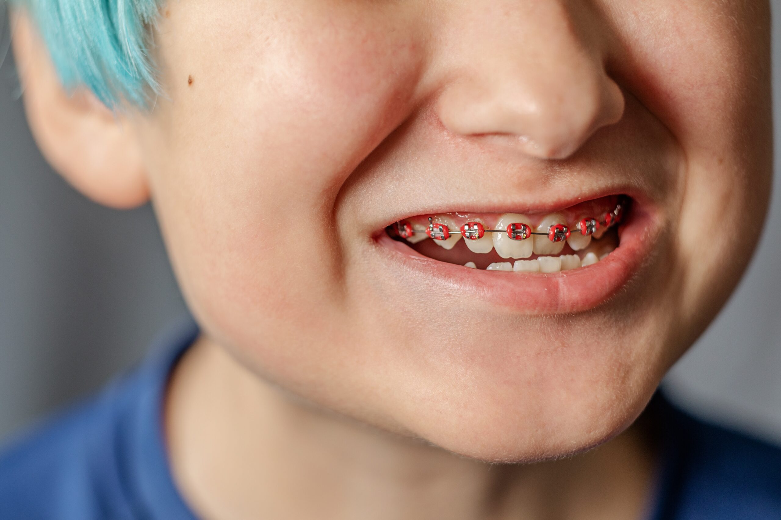 Teen treating an underbite with braces.