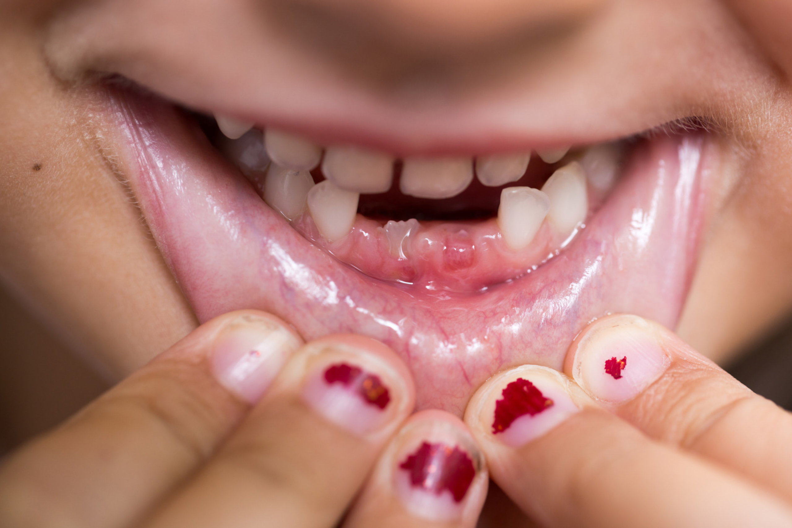 delayed tooth eruption